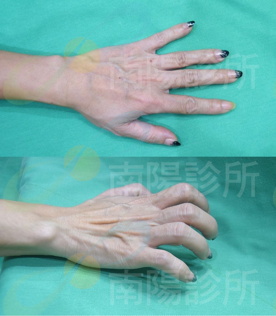 【自体脂肪移植】挥别乾瘪骨感鸡爪手,teresa变身玉脂凝肌贵妃手